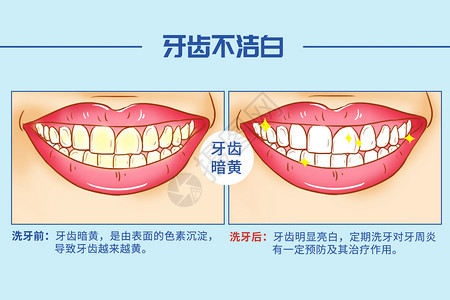 亮润白面霜洗牙口腔医学插图插画