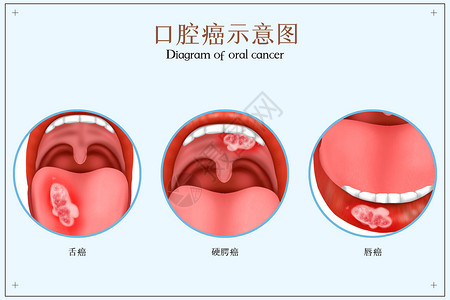 肛门癌口腔癌医疗配图插画