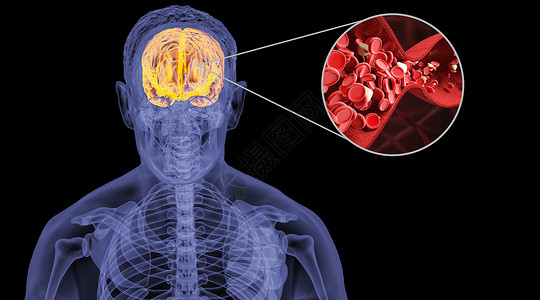 人体脑淤血脑部按摩高清图片
