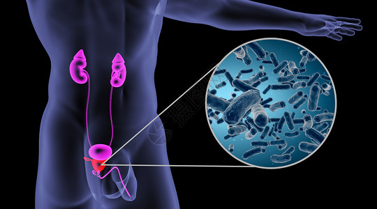 前列腺结石人体前列腺感染场景设计图片