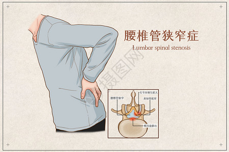 腰椎管狭窄症医疗插画背景图片