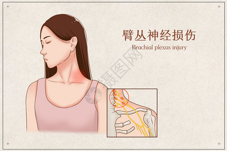 臂丛神经损伤医疗插画图片