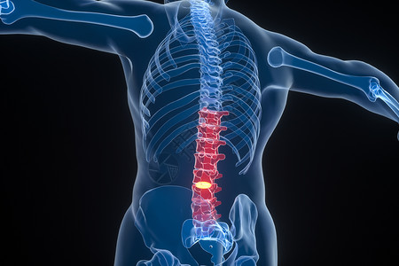 脊柱结构腰椎间盘突出症场景设计图片