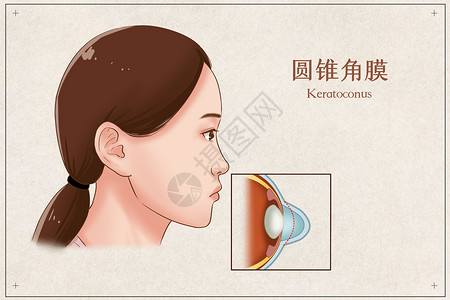 圆锥角膜医疗插画高清图片