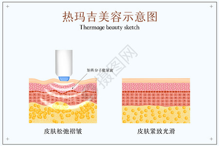 美容护肤模特热玛吉美容紧致肌肤示意图插画