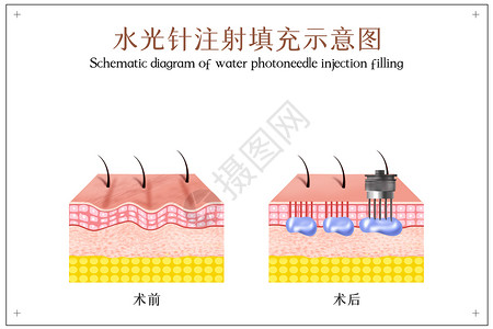 紧致水光针注射美容医美配图插画