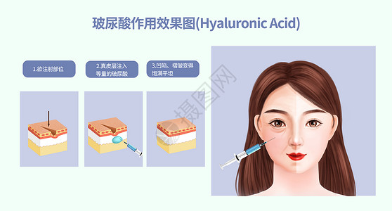 3的效果图玻尿酸作用效果图插画