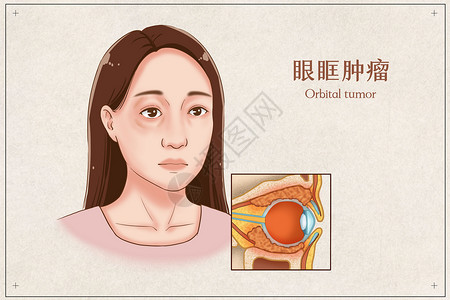 眼科学眼眶肿瘤医疗插画插画