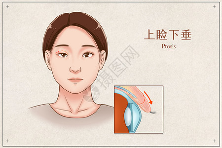 关注眼健康字体上睑下垂医疗插画插画