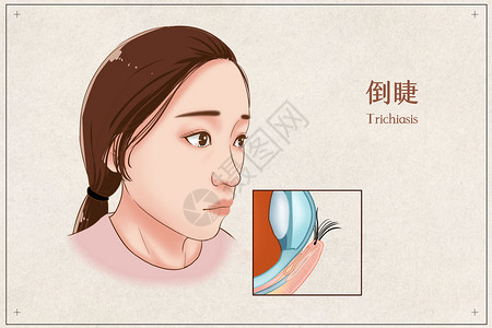 倒睫医疗插画背景图片