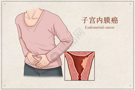 子宫内膜癌医疗插画高清图片