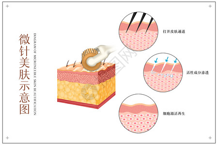 玻尿酸除皱微针美肤医美配图插画