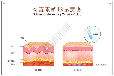 肌肉素材图肉毒素塑形医美配图插画