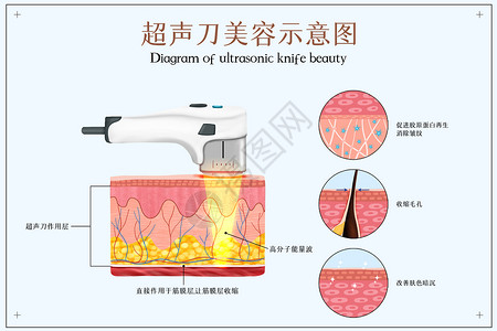 高分子凝胶超声刀美容医美配图插画