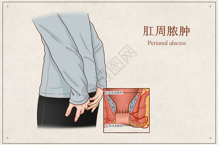 肛周脓肿医疗插画图片