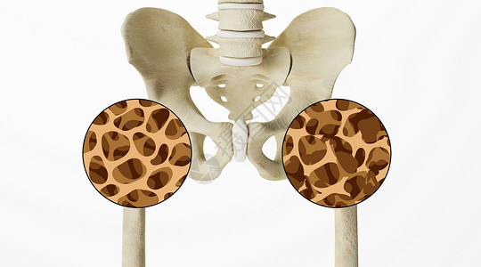 骨盆人体骨质疏松场景设计图片