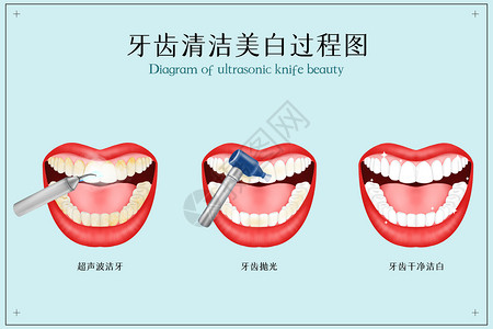 超声波扫描牙齿清洁美白医疗配图插画