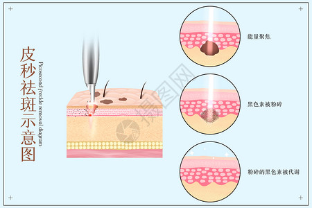 皮秒祛斑医美配图插画