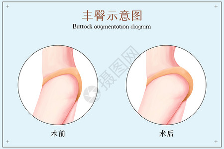 臀部美容丰臀前后医美配图插画