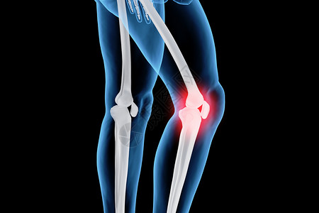 膝关节疼C4D膝盖疾病设计图片