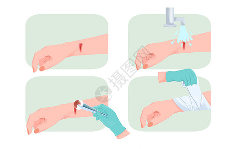 伤口素材医疗手部受伤处理包扎伤口过程插画