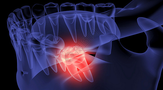牙齿X光口腔智齿疼痛设计图片
