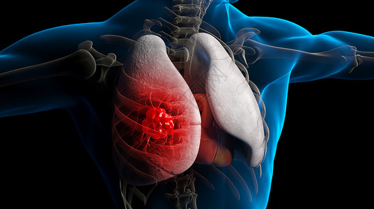肺病肺癌3D疾病场景高清图片
