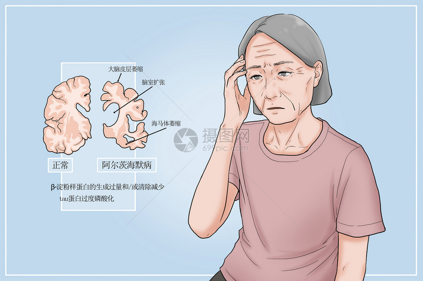 阿尔茨海默病病因医疗插画