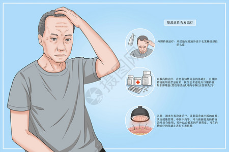 雄激素性秃发治疗方法医疗插画高清图片