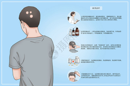 治疗斑秃方法医疗插画图片