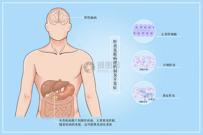 肝炎发展病理机制及并发症医疗插画图片