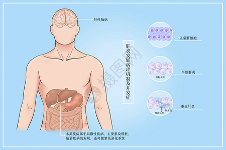 肝炎发展病理机制及并发症医疗插画背景图片