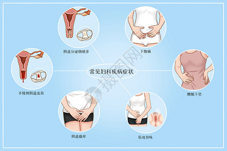 常见妇科疾病症状医疗插画临床高清图片素材