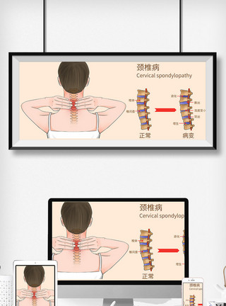 脊柱外科颈椎病科普医疗插画模板
