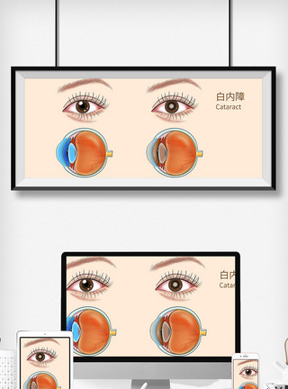 眼科设备白内障科普医疗插画模板