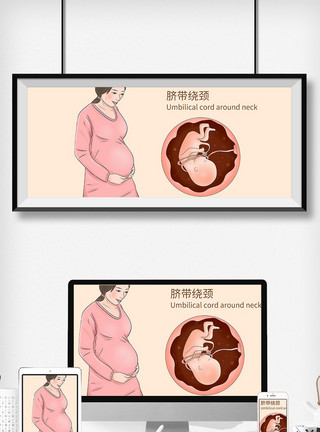 孕产妇脐带绕颈科普医疗插画模板