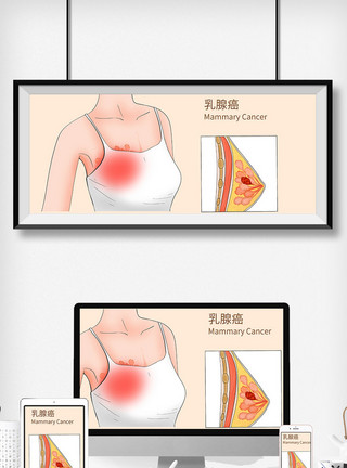 乳腺彩超乳腺癌科普医疗插画模板