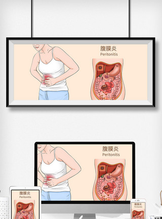 嘴角溃疡腹膜炎科普医疗插画模板