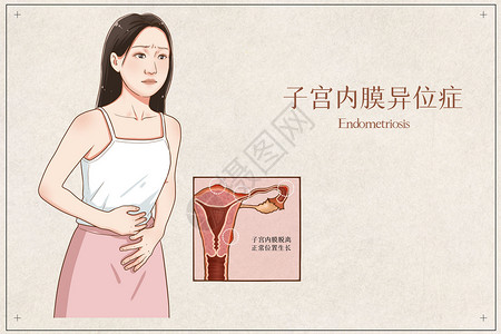 肌肉女子宫内膜异位症医疗插画插画