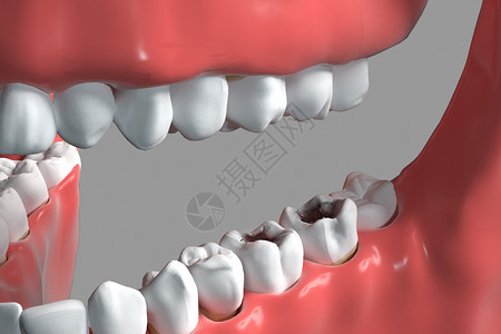 三维牙齿蛀牙背景背景图片