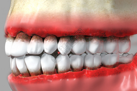 三维牙龈炎疾病背景设计图片