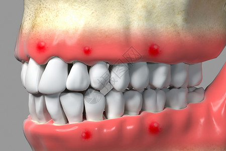 牙龈炎三维牙周病背景设计图片