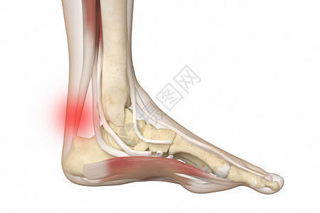 三维跟腱炎场景图片
