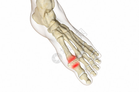 三维痛风疾病场景高清图片