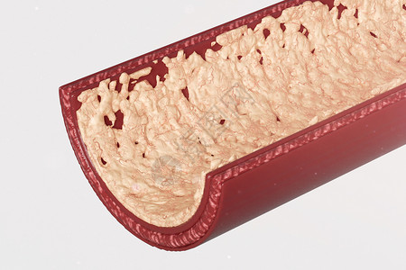 脂质块三维动脉粥样硬化剖面模型设计图片