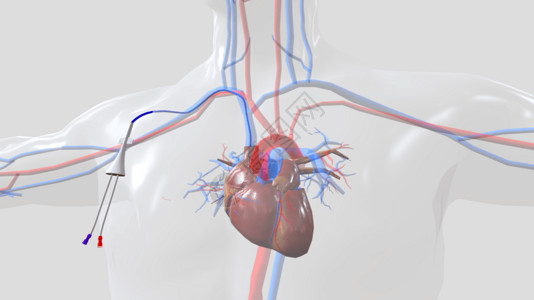 心脏导管外部固定位置图片