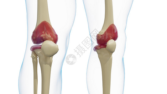 发炎的膝关节-膝盖类风湿性关节炎图片素材