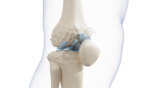 膝关节创伤后关节炎图片