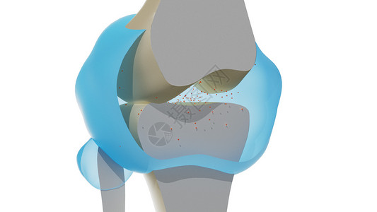 提高医疗水平组织水平炎症(膝盖累风湿性关节炎）（动画）设计图片