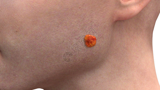 面部基底细胞癌一期高清图片